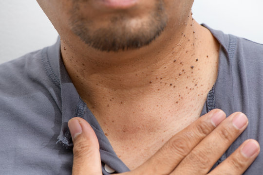 Skin Tag Removal Therapy for Men