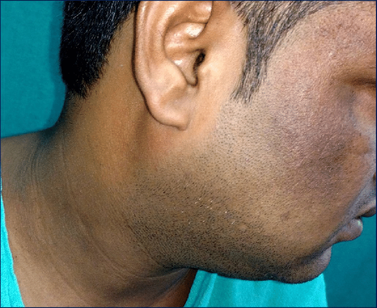 Pigmentation Therapy for Men