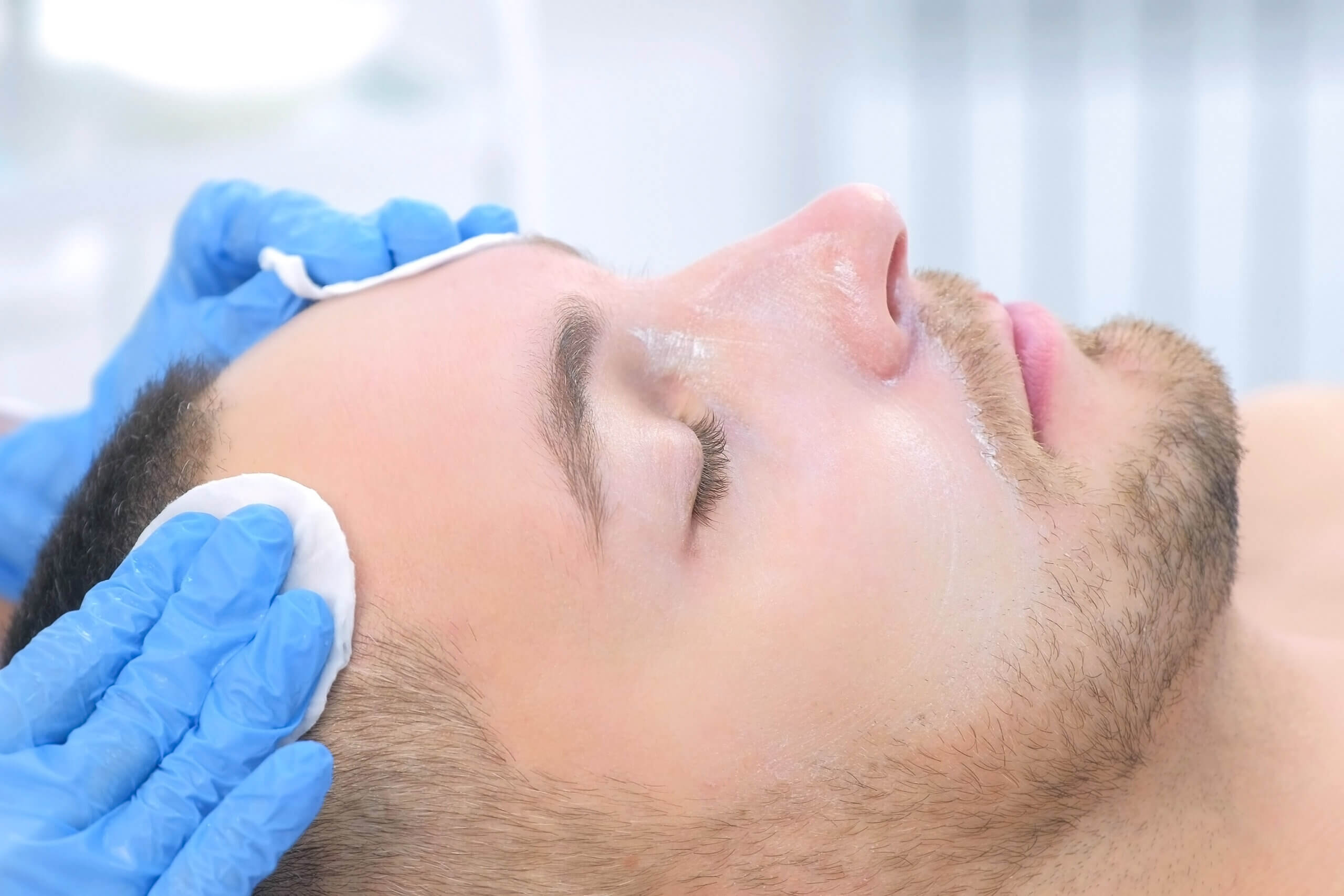 Chemical Peel Therapy for Men